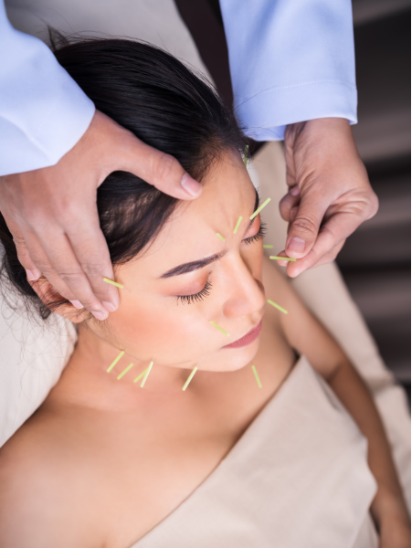 acupuncture